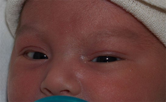 eyes dysconjugate movement Janelle Aby, MD, Stanford Medical Center.jpg